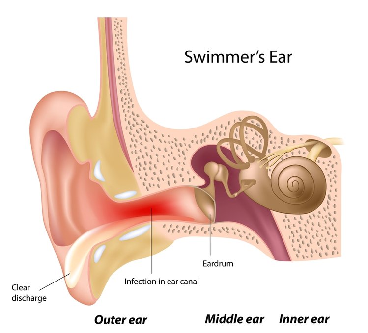 Zdjęcie Zalegająca woda w uchu może prowadzić do poważnych infekcji. Sprawdź, jak ją usunąć #1