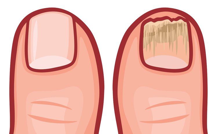 Zdjęcie 2 rodzaje grzybicy stóp – jak rozpoznać symptomy choroby? #2