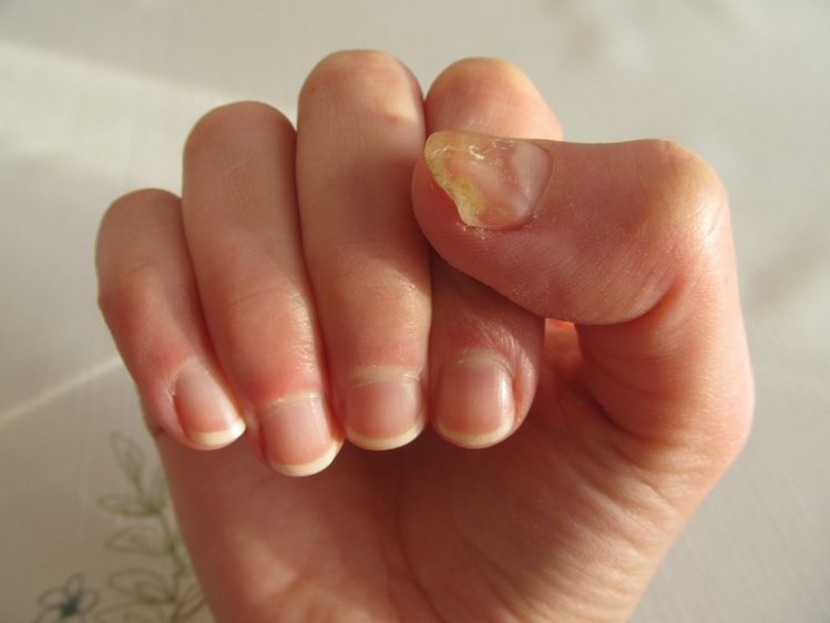 Zdjęcie Problem z żółtymi paznokciami? Pozbądź się ich dzięki temu domowemu sposobowi! #1