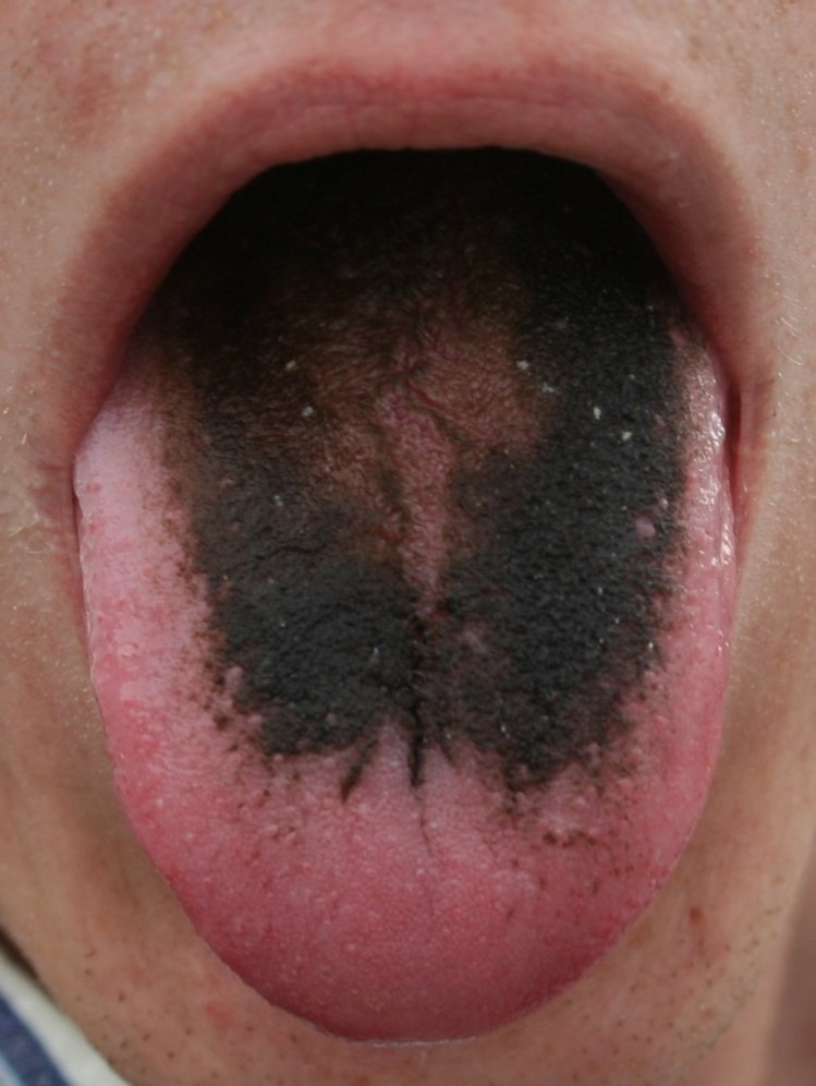 Zdjęcie Czarny język włochaty u jednej ze szpitalnych pacjentek. To może przytrafić się każdemu #1