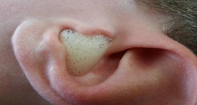 Zdjęcie Nie czyść uszu patyczkami! Oto 5 sprawdzonych sposobów #2