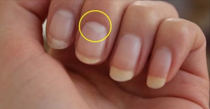 Zdjęcie Przyjrzyj się swoim obłączkom (biały fragment paznokcia)  - wiele mówią na temat twojego zdrowia #2
