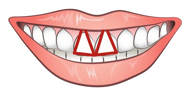 Zdjęcie Czy kształt Twoich zębów określa Twój charakter? #3