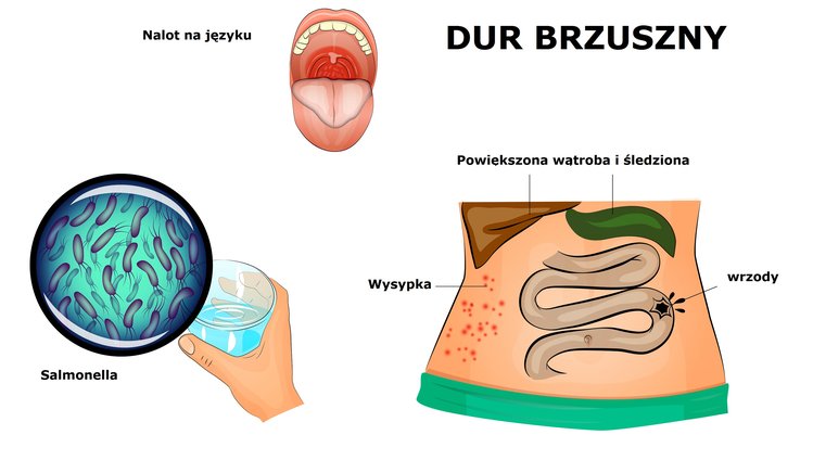 Zdjęcie Dur brzuszny - niebezpieczna choroba zakaźna. Zobacz jakie ma objawy i jak ją leczyć #2