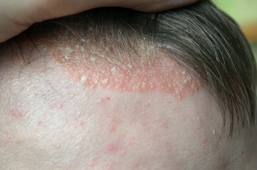 Zdjęcie Problemy ze skórą głowy? Sprawdź, czy nie masz jednej z tych chorób #2