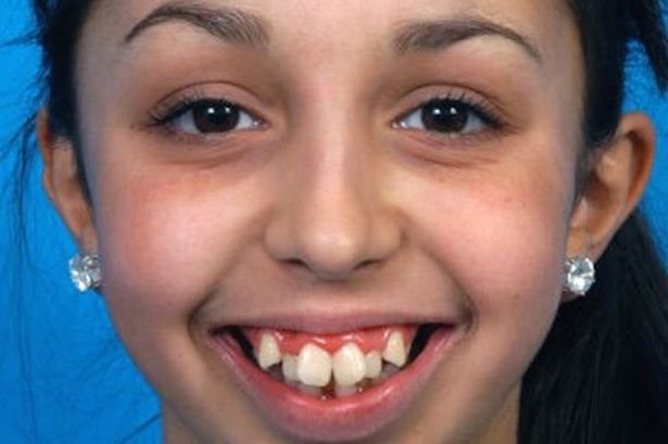 Zdjęcie Dziewczyna z niewiarygodnie krzywymi zębami przeszła przez piekło. Dziś już tak nie wygląda #1