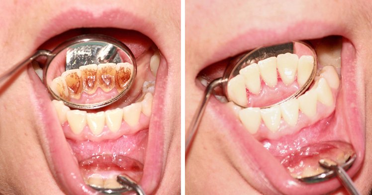 Zdjęcie Większość z nas myśli, że potrafi zadbać o higienę jamy ustnej. Jednak często popełniamy te błędy #3