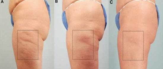 Zdjęcie Najnowsza metoda na cellulit - szczotkowanie ciała na sucho! #1