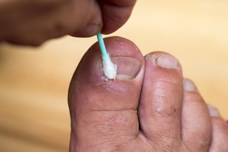 Zdjęcie Grzybica paznokci – jak leczyć ją domowymi środkami? #2