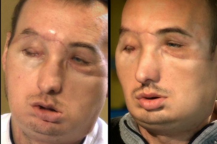 Zdjęcie Pan Grzegorz- pierwszy Polak z przeszczepioną twarzą- poznaj jego historię #1