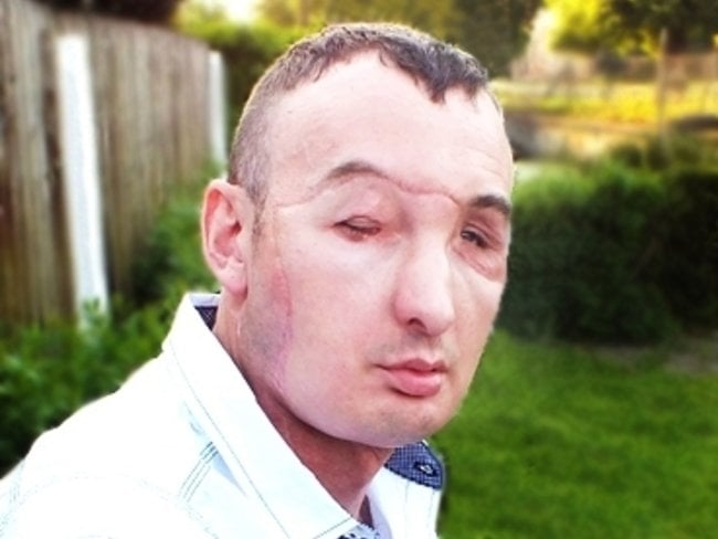 Zdjęcie Pan Grzegorz- pierwszy Polak z przeszczepioną twarzą- poznaj jego historię #2