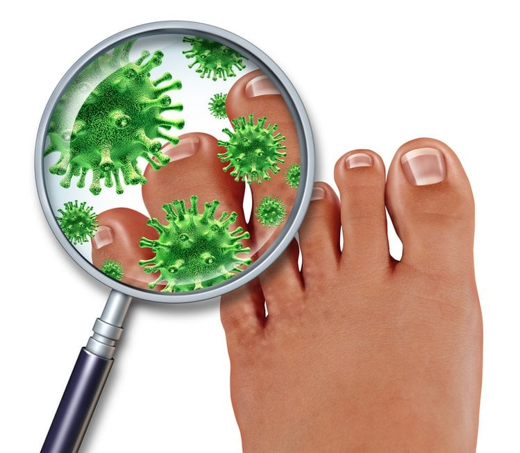 Zdjęcie 2 rodzaje grzybicy stóp – jak rozpoznać symptomy choroby? #3