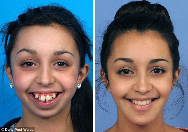 Zdjęcie Dziewczyna z niewiarygodnie krzywymi zębami przeszła przez piekło. Dziś już tak nie wygląda #2