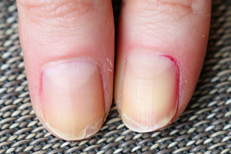 Zdjęcie Zmiany na paznokciach, których nie należy lekceważyć! Co oznaczają poszczególne z nich? #4