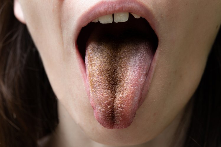 Zdjęcie Czarny język włochaty u jednej ze szpitalnych pacjentek. To może przytrafić się każdemu #2