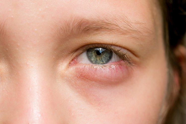 Zdjęcie Dlaczego masz opuchnięte oczy? Poznaj 6 możliwych przyczyn #1