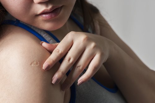Zdjęcie Posiadasz taką bliznę po szczepieniu na ramieniu? Dowiedz się, jaka jest jej przyczyna #1