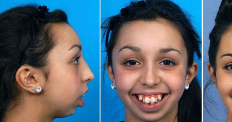 Zdjęcie Dziewczyna z niewiarygodnie krzywymi zębami przeszła przez piekło. Dziś już tak nie wygląda #4