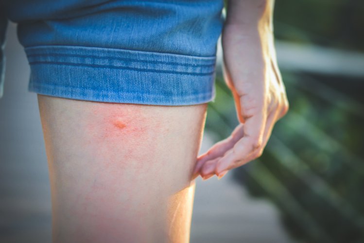 Zdjęcie Ugryzienie komara- jak złagodzić uczucie swędzenia? #1