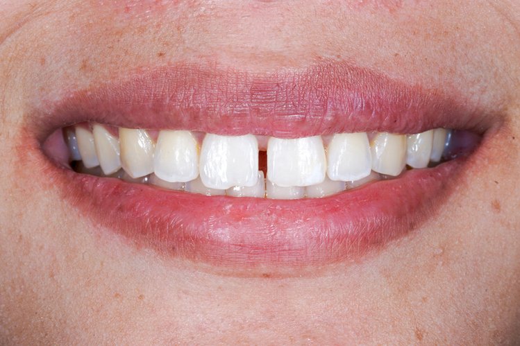 Zdjęcie Masz przerwę między zębami? Sprawdź, co mówi to o twojej osobowości! #1